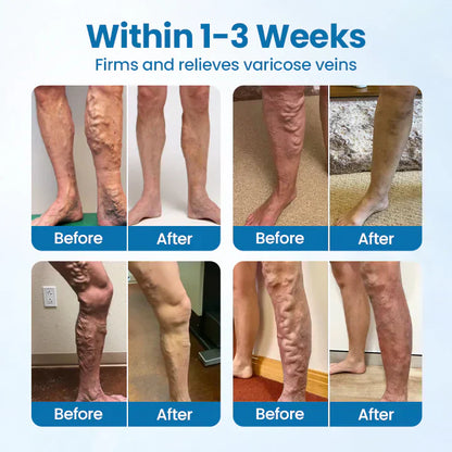 HEALRIZE® VeinGuard Herbal Spray-✅ Clinically proven to eliminate varicose veins in just 7 days!